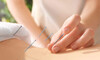 45-Minute Acupuncture Treatment