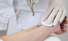 Delete Laser Tattoo Removal